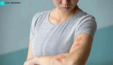 nhs shingles treatment